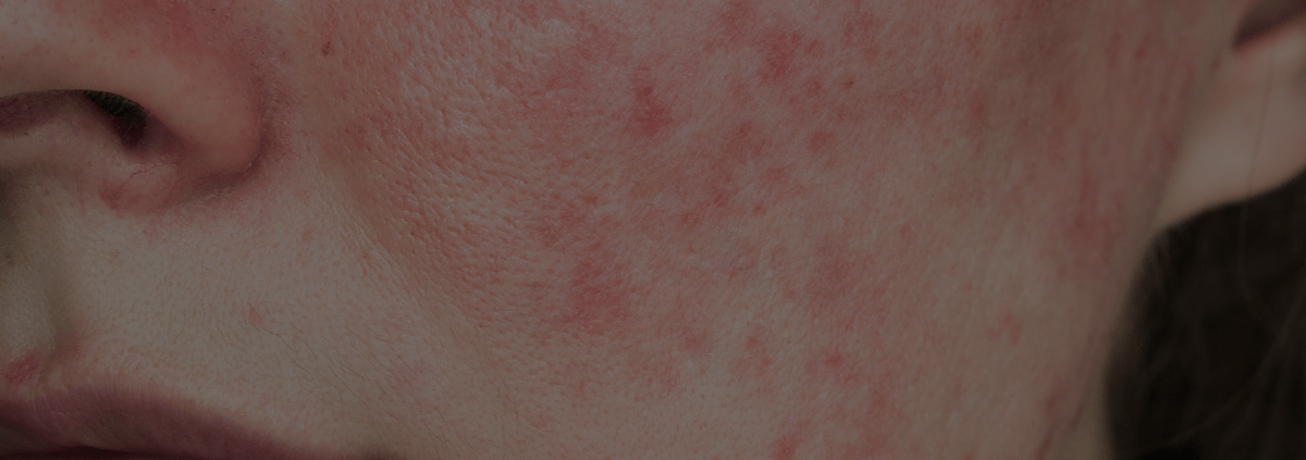 Rosacea axelsonsspa