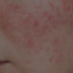 Rosacea axelsonsspa