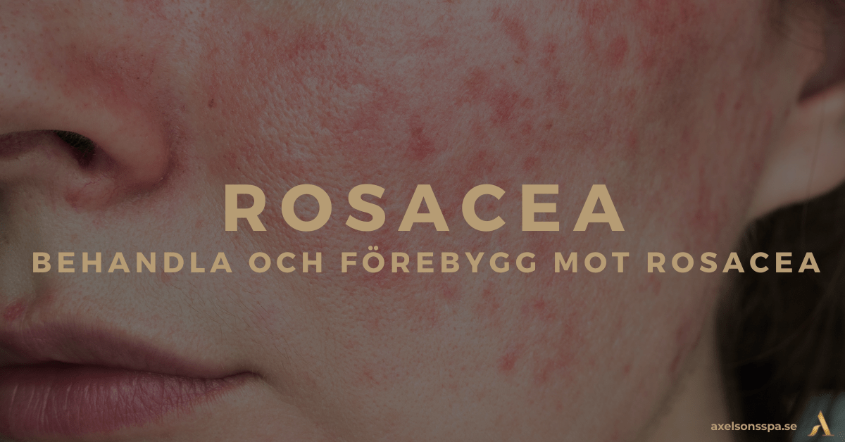 Rosacea